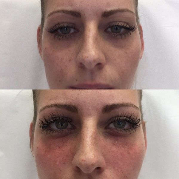 Risiken Bei Wangenaufbau Mit 1 Ml Juvederm Voluma Restylane Juvederm Surgiderm Teosyal Matridex Matridur Derivate Der Hyaluronsaure Forum Estheticon De