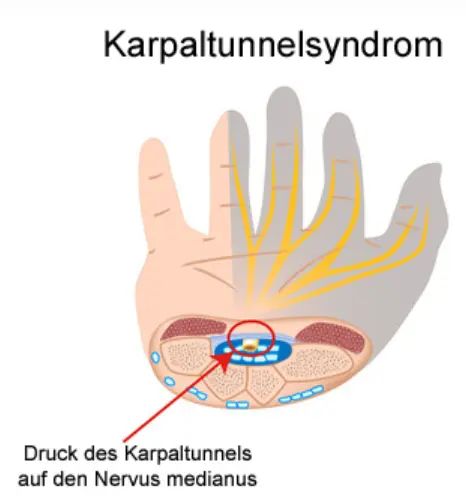 karpaltunnel riedel