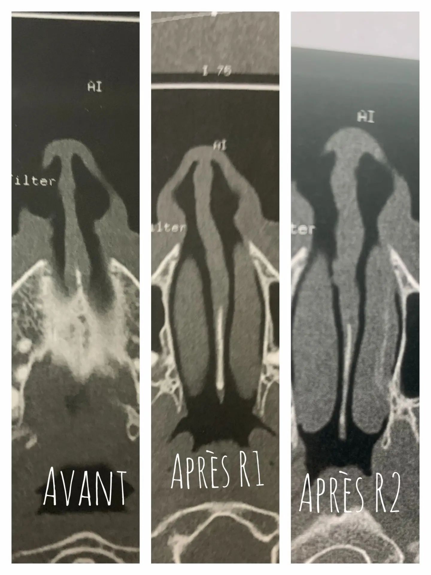 Persistance de la déviation après 2 rhinoseptoplasties Septoplastie (opération de la cloison