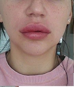 Zu Grosse Lippen Nach Unterspritzung Mit 0 5ml Vor 2 en Lippenvergrosserung Mit Hyaluronsaure Forum Estheticon De