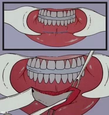 genioplastik1