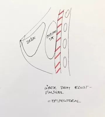 Implantat liegt über dem Brustmuskel