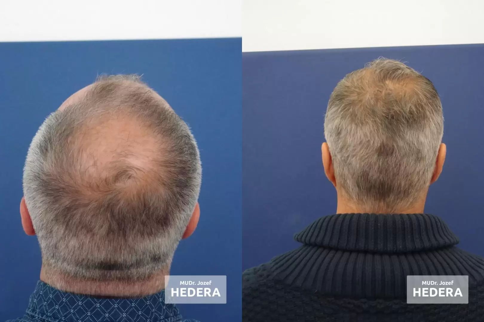 výsledok transplantácie vlasov, pred po