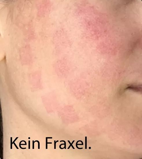 2 Kein Fraxel