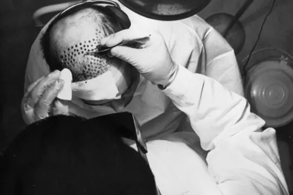 How much does hair transplant cost