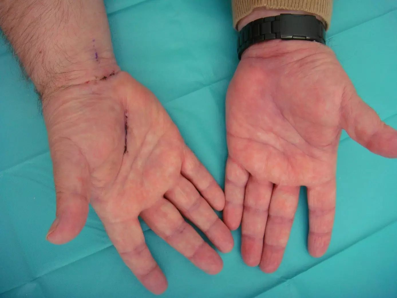 Narbenarme Technik der Operation des Karpaltunnelsyndroms | Estheticon.de