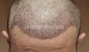 Haartransplantation Wann Fallen Die Krusten Ab Estheticon De