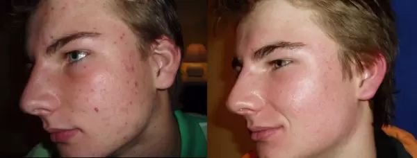 akné po ošetrení laserom