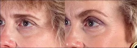 brow lift lifting