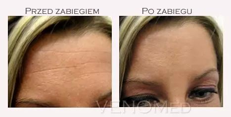 Botox Jendrysik