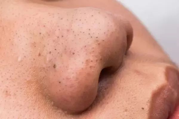 akné čierne bodky na nose, upchaté póry