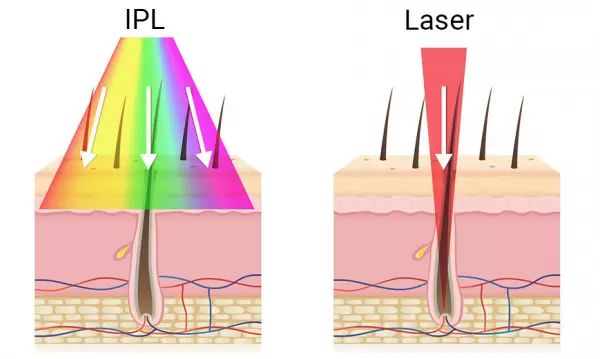 IPL laser rozdílvlnové dĺžkysvetla