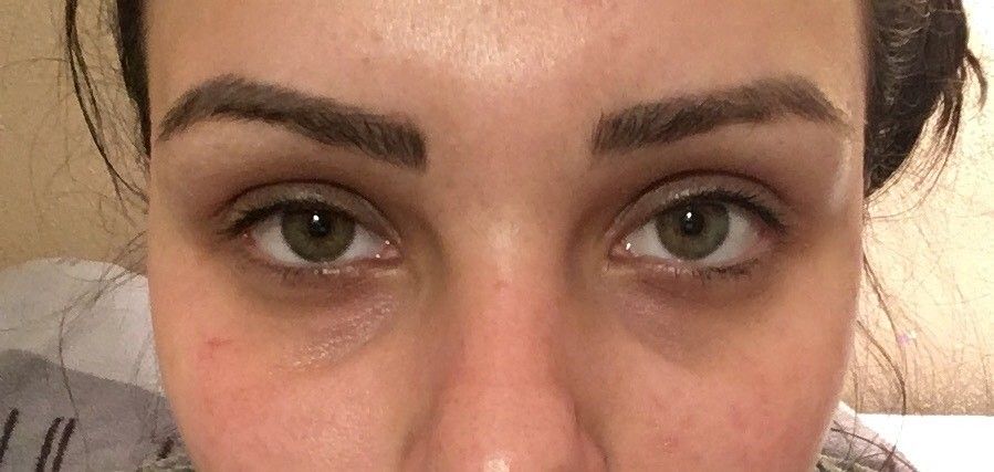 Beste Behandlungsmethode Gegen Dunkle Augenringe Unterlidstraffung Tranensacke Entfernen Forum Estheticon De
