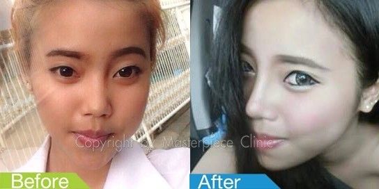 Asiatische Nase Einlegen Von Ohrknorpel Oder Silikon Nasenkorrektur Rhinoplastik Forum Estheticon De