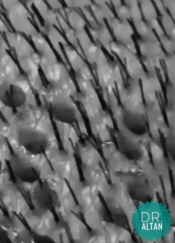 what does hair transplant cost