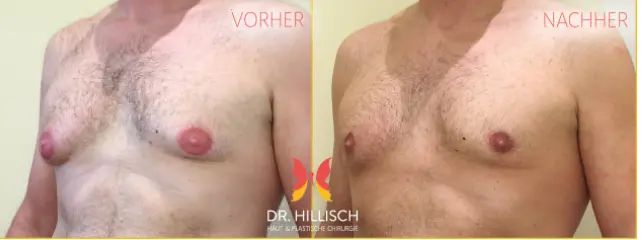 männerbrust hillisch