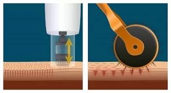 Microneedling4
