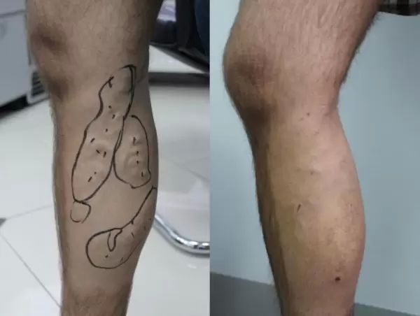 Leczenie zylakow para wodna Rybak