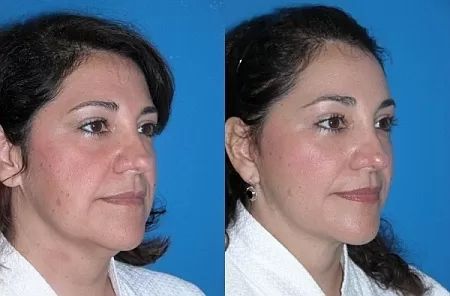 SMAS face lift