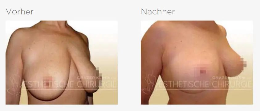 straffung mit 75C