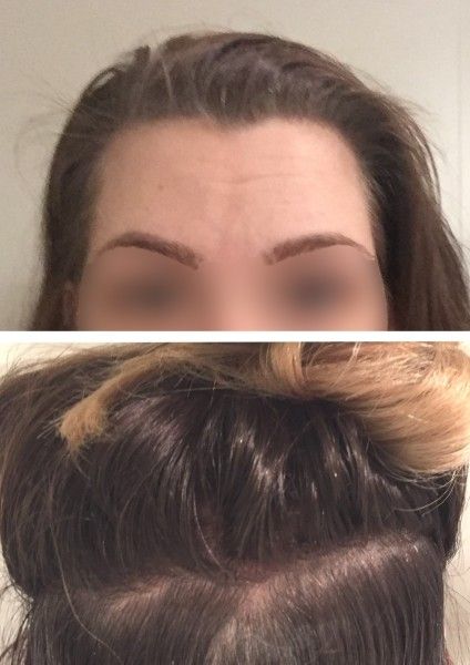 Arztliche Einschatzung Geheimratsecken Bei Frau Haartransplantation Forum Estheticon De