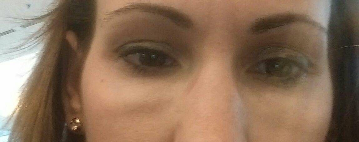 Schwellung Unter Dem Auge 2 Jahre Nach Hyaluron Gegen Augenringe Restylane Juvederm Surgiderm Teosyal Matridex Matridur Derivate Der Hyaluronsaure Forum Estheticon De