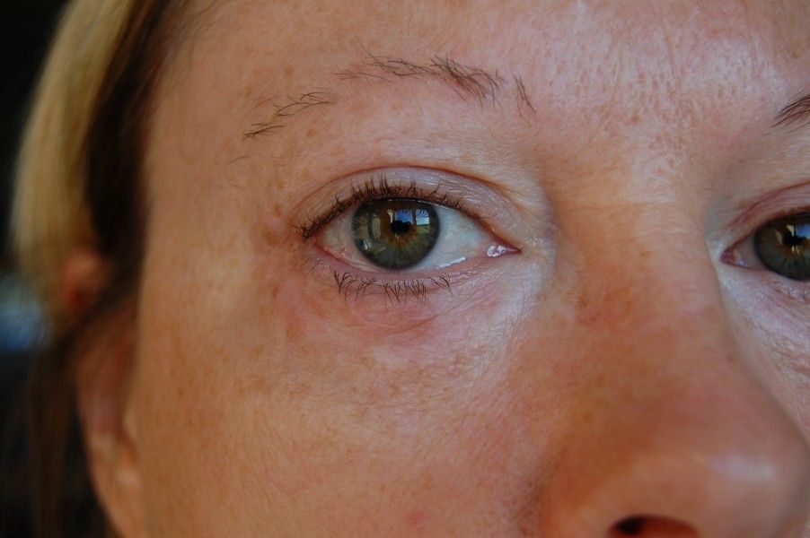 tache rouge paupière inférieure après blépharoplastie - Blépharoplastie ...