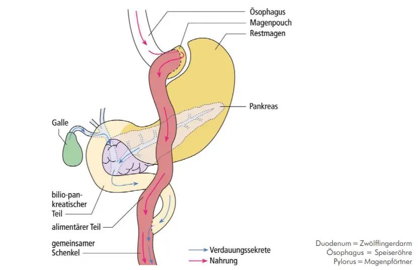 magenbypass