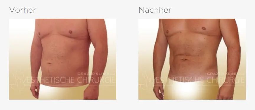 lipo mann