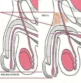 prodloužení penisu, obrázek chirurgické metody prodloužení penisu