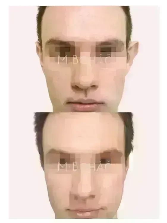 Otoplastika