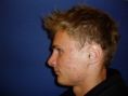 Laser acne treatment - Photo before - Klinika Laser Esthetic