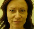 Eyelid surgery (Blepharoplasty) - Photo before - Klinika Laser Esthetic