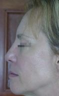 Fotorejuvenecimiento (IPL) - rejuvenecimiento de la piel - Foto Antes de - Dr. Aristides Arellano-Huacuja