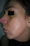Acne laser, Cicatrici da acne laser - Foto del prima - Dott. Dario d