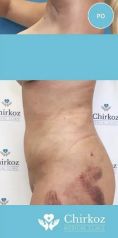 Liposukcia vodným lúčom (body-jet, Water-jet, WAL) - Fotka pred - Chirkoz Medical Clinic