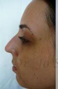 Septoplasty - Photo before - Dr. med. Jozefina Skulavik