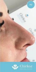 Radiesse (Calcium hydroxylapatit) - Fotka pred - Chirkoz Medical Clinic