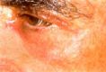 Eyelid surgery (Blepharoplasty) - Photo before - Klinika Laser Esthetic