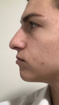 Cirugía de la nariz (Rinoplastia) - Foto Antes de - Dr. Diego Cunille