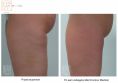 Ultrasonic cavitation - Photo before - Bieńkowscy Clinic®