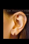 Ear surgery (Otoplasty) - Photo before - Dr. Rodrigo Morales De la Cerda