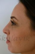 Septoplasty - Photo before - Dr. med. Jozefina Skulavik