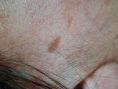 Traitements laser - dermatologie esthétique - Cliché avant - Dr Pierre-Alain Mayeux