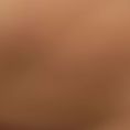 Breast Augmentation - Breast Implants - Photo before - Adam J. Rubinstein M.D., FACS