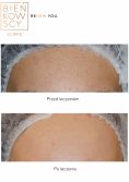 Fractional Laser Resurfacing - Photo before - Bieńkowscy Clinic®