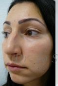 Septoplasty - Photo before - Dr. med. Jozefina Skulavik