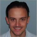 Haartransplantation - Vorher Foto - Prohaarklinik