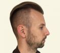 Nasenkorrektur - Rhinoplastik - Vorher Foto - AESTHEVITA