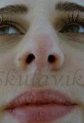 Septoplasty - Photo before - Dr. med. Jozefina Skulavik